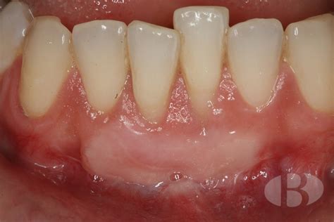 Tratamiento De Absceso Gingival Recidivante Mediante Un Injerto