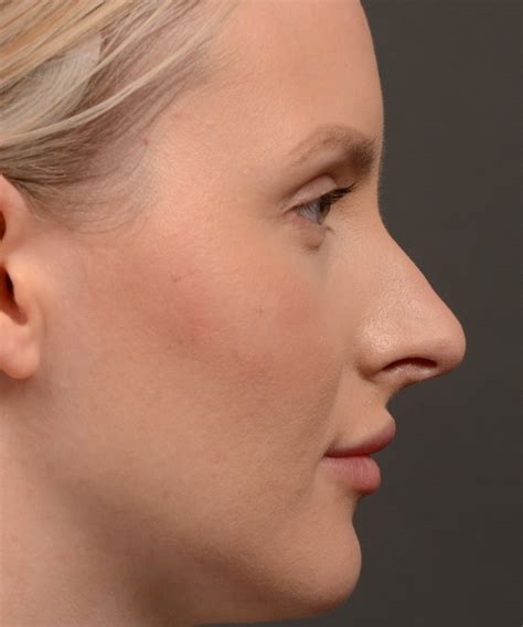 Rhinoplasty Before And After Case 447 Toronto Rhinoplasty Surgery