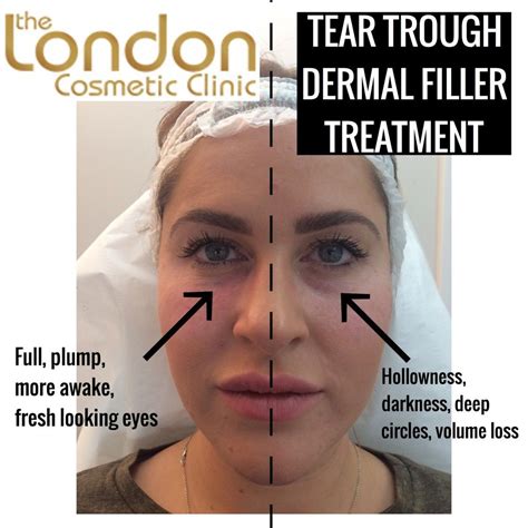 Under Eye Fillers Face Fillers Dermal Fillers Dark Circles Makeup