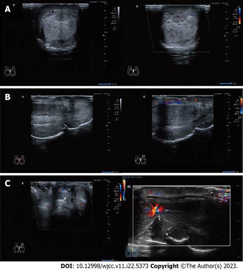 Preoperative Doppler Ultrasonography The Image Depicts The Color