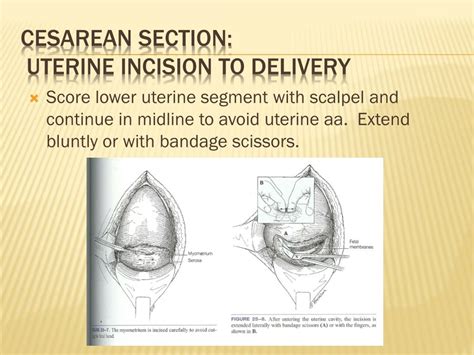 Cesarean Section Clinical Presentation