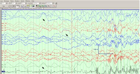 Needlestick-Induced-Reflex-Anoxic-Seizures-and-Successful-Treatment-with-Intranasal-Midazolam--A ...