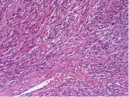 Molecular And Immunohistochemical Evidence For The Origin Of Uterine