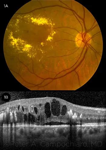 Diabetic Macular Edema—Personalizing Treatment - American Academy of Ophthalmology