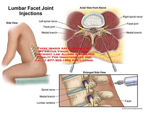 Zygapophyseal Joint