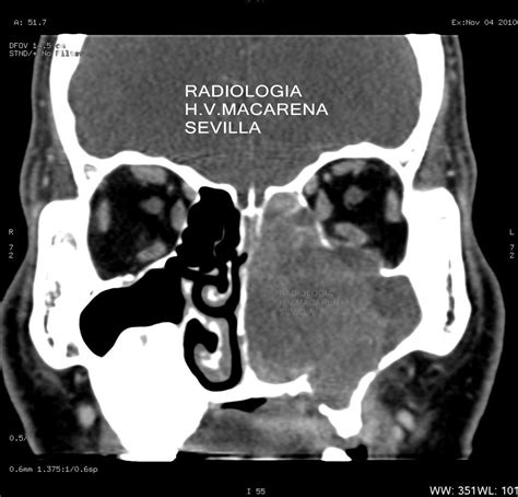 Carcinoma De Células Pequeñas Neuroendocrino Radiologia De Cabeza Y Cuello