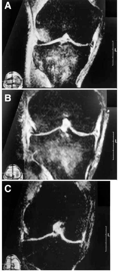 A C A First Examination In A Patient With Bone Bruise A Diffuse Area Download Scientific