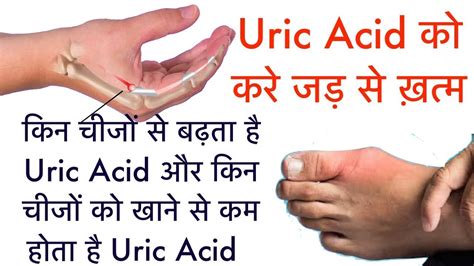 Uric Acid को करे जड़ से ख़त्म किन चीजों से बढ़ता है Uric Acid किन चीजों को खाने से कम होता है