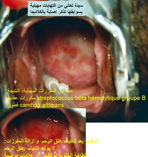 طبيب الوب أمراض المهبل و الفرج ـ التهابات الجهاز التناسلي السفلي د