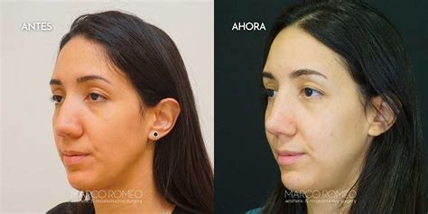 Rinoplastia Antes Y Despu S Caso Ml Dr Marco Romeo