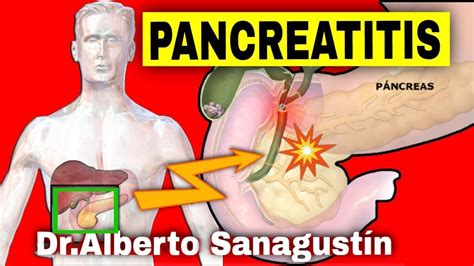 Pancreatitis Aguda Y Cr Nica S Ntomas Causas Y Tratamiento Youtube