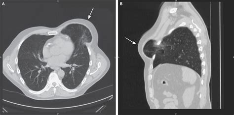 Lung Herniation After Minimally Invasive Cardiothoracic Surgery — Nejm