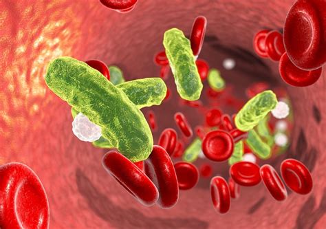 Septicaemia Symptoms - Homeopathy Plus