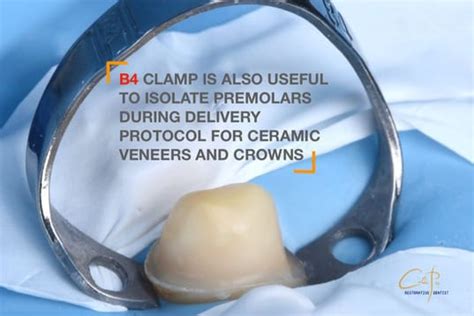 Rubber Dam Isolation Technique Dental Guide For Clamp Selection