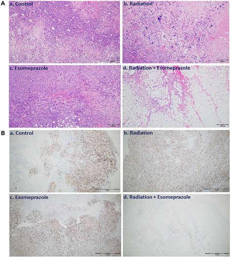 Combination Of Esomeprazole And Radiation Reduces Cancer Cell Growth