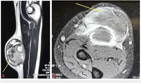 MRI Shows Subcutaneous Enhancing Soft Tissue Lesion With Internal