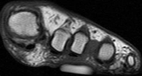 Morton Neuroma Image