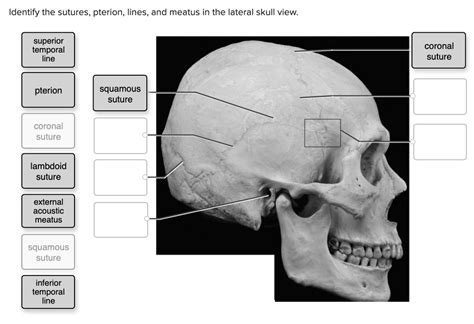 SOLVED: Identify the sutures, pterion, lines, and meatus in the lateral ...