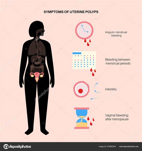 Uterine Polyps Syndroms Endometrial Disease Overgrowth Cells Uterus