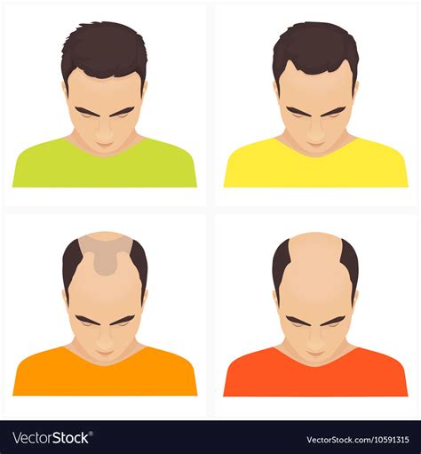 Hair Loss Stages In Men Royalty Free Vector Image