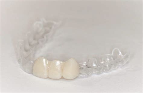 Essix Retainers – Dentists in Surrey | Vivant Dental