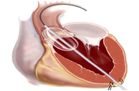 Percutaneous Balloon Valvoplasty