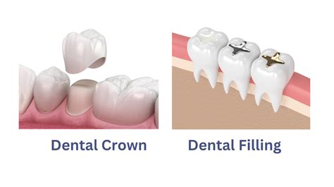 What Is The Difference Between A Dental Crown And Dental Filling Gentle Dental Maine