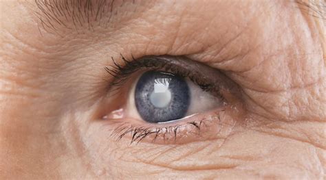 Four Causes Of Cataracts And How Theyre Treated Curtis Frank Od