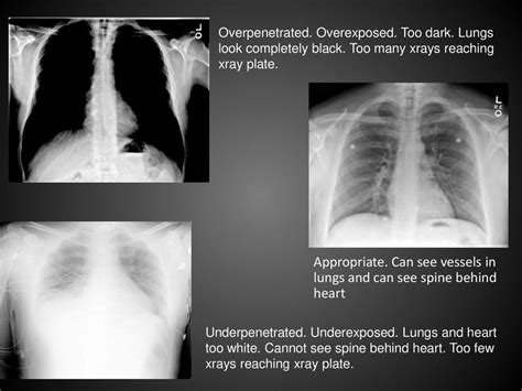 Tcm2 Radiology Pre Exam Review Semester One Chest X Ray Pathology Ppt