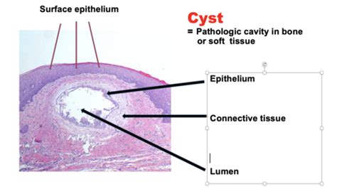 Cysts Of The Jaws And Neck Flashcards Quizlet