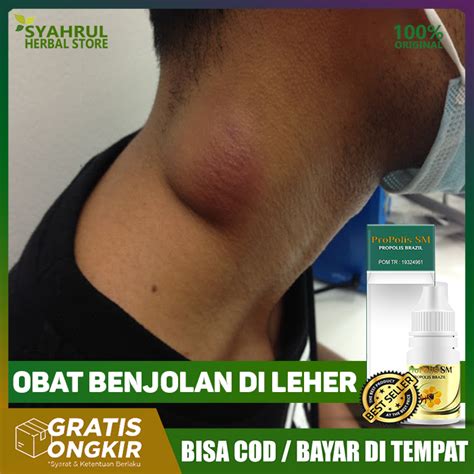 Obat Benjolan Di Leher Infeksi Kelenjar Tiroid Benjolan Lipoma