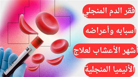 أشهر الأعشاب لعلاج فقر الدم المنجلي أسباب وأعراض الأنيميا المنجلية