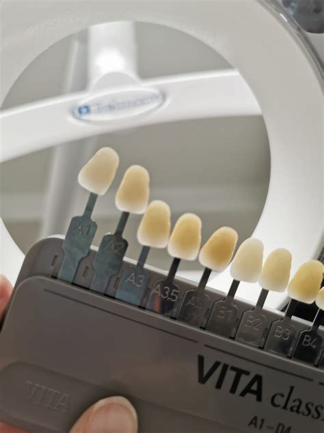 🦷What are Veneers? Veneers are thin... - Dental Logic Truro