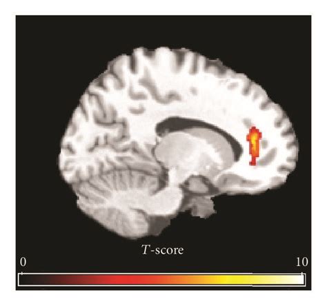 Group Activation Maps Of Mean Cerebral Blood Flow Cbf Changes Between