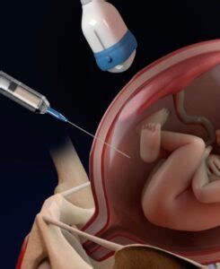 Cirurgia Fetal Fetali Medicina Fetal E Ultrassonografia