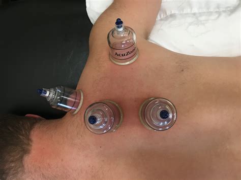 Cupping Birmingham Physical Therapy And Sports Medicine