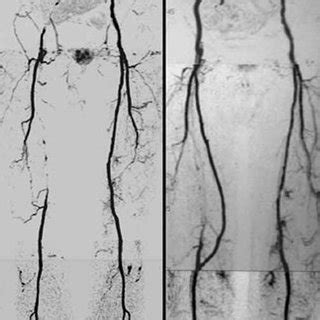 Preoperative Contrast Enhanced Three Dimensional MR Angiography Of A