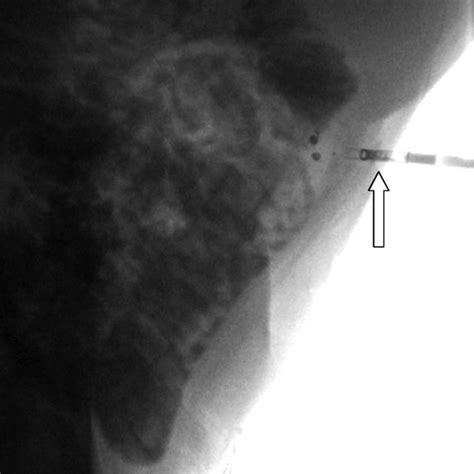 Lateral Fluoroscopic View Following Catheter Administration Of Water