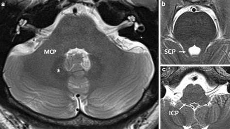 The dentate nucleus and cerebellar peduncles. The dentate nucleus ...