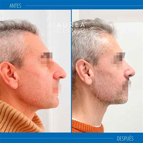 Rinoplastia Sevilla Para Tu Operaci N De Nariz Aurea Clinic