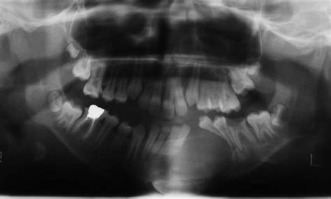 Of Ultrasonography In Maxillofacial Intraoral Benign And Malignant