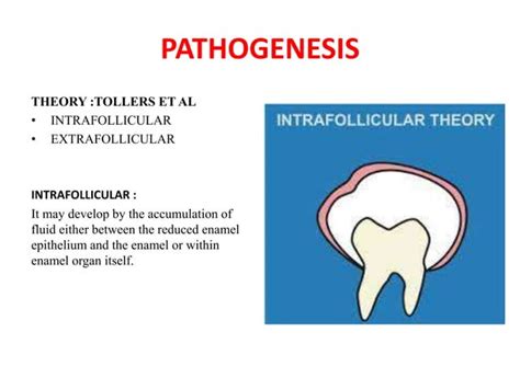 Dentigerous Cyst Ppt