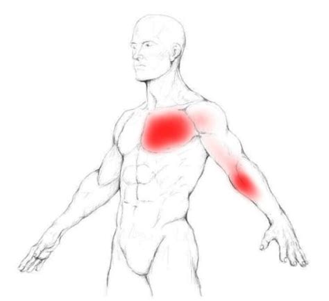 Pectoralis major muscle pain & trigger points