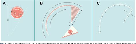 Figure 7 From Flap Basics I Rotation And Transposition Flaps