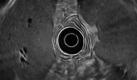 Top Tips Regarding Eus Guided Liver Biopsy Gastrointestinal Endoscopy