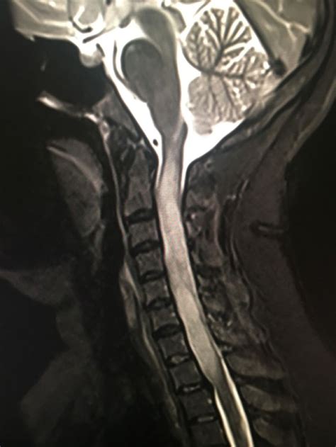 Spinal Cord Astrocytoma Radiology Imaging Radiology Spinal Cord