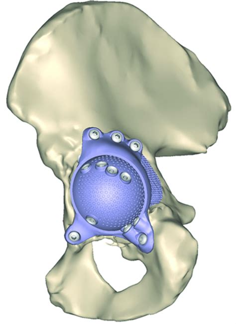 The Accuracy Of Positioning Of A Custom Made Implant Within A Large Acetabular Defect At