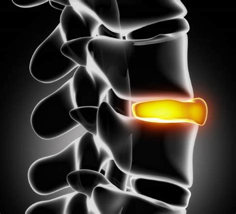 Bandscheibenvorfall Der Halswirbels Ule Hws Symptome Diagnose Und