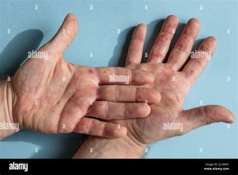 Hives On Palms Of Hands