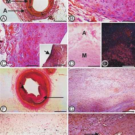 A Low Power Photomicrograph Of Advanced Atherosclerotic Lesion With